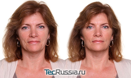 Фото до и после озонотерапии по лицу