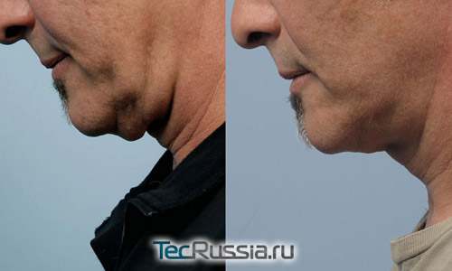 Фото до и после коррекции шеи с помощью Neck Tite