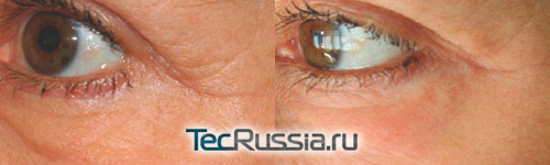 До и после обработки области вокруг глаз, аппарат Mixto