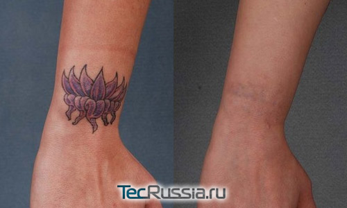 До и после удаления татуировки