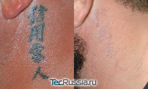 До и после удаления татуировки
