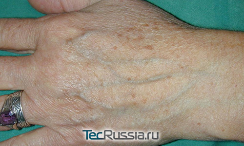 морщины и пигментация на кистях рук