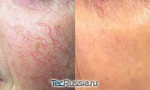 фото до и после лазерной терапии купероза