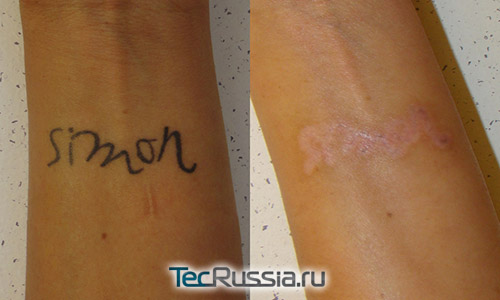 До и после лазерного удаления татуировки