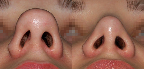 Фото до и после ринопластики (хирург – Григорянц В.С.)