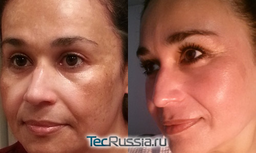 До и после лечения мелазмы (хлоазмы) на лице