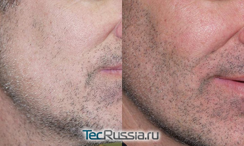 фото до и после пересадки бороды