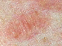 Сосудистые пятна на коже лица лечение thumbnail