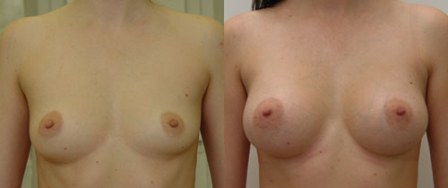 эндоскопическая пластика груди, хирург Валерий Якимец – фото до и после операции