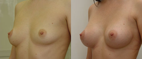 до и после эндоскопической пластики груди