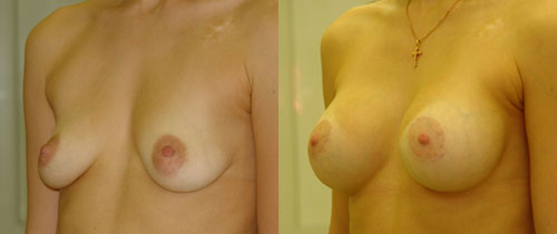 Птоз с увеличением груди, хирург В.Якимец – фото до и после операции