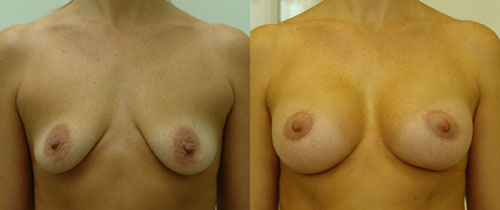 Фото до и после увеличения груди с коррекцией птоза