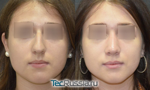 пациентка 5, фото до и после ринопластики