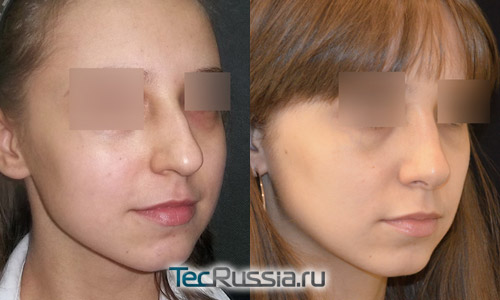 пациентка 3 до и после пластики носа, профиль, хирург Алексанян Т.А.