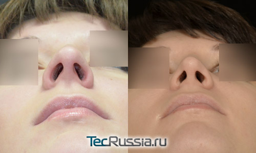 пациентка 2 до и после ринопластики, вид носа снизу, хирург Алексанян Тигран Альбертович