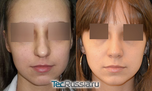 пациентка 3 до и после пластики носа, хирург Алексанян Т.А.