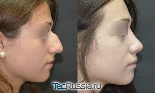пациентка 5, фото до и после ринопластики, профиль