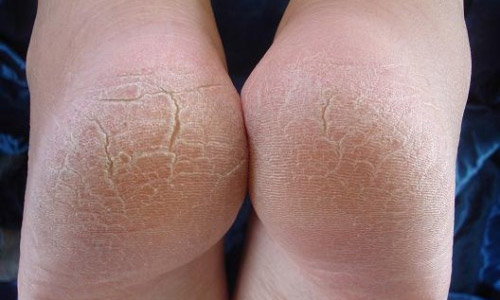 У меня некрасивая кожа ног thumbnail