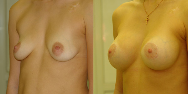 Фото до и после подтяжки груди, хирург Якимец В.Г.