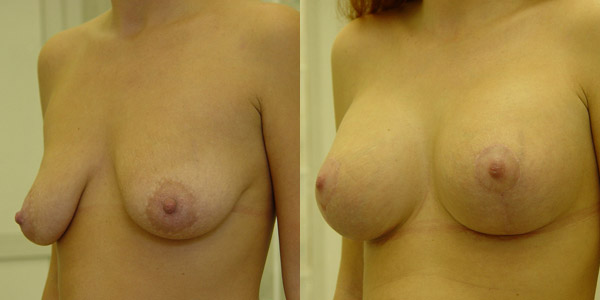 Фото до и после подтяжки груди, хирург Якимец В.Г.
