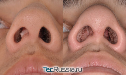 фото до и после пластики носовой перегородки