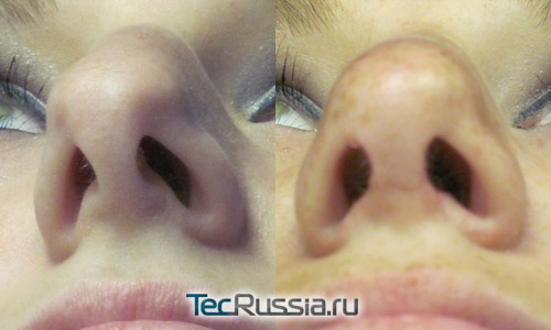 фото до и после пластики носовой перегородки в сочетании с открытой ринопластикой
