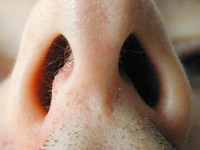 Искривление носовой перегородки – чем оно грозит и как его исправить?