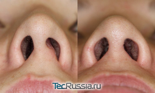 до и после операции на искривленной носовой перегородке