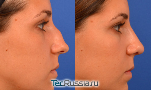 Удаление горбинки на носу – фото до и после