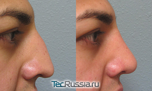 Фото до и после операции по удалению горбинки с носа