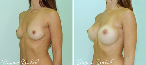 фото до и после увеличения груди, хирург В.С. Баков
