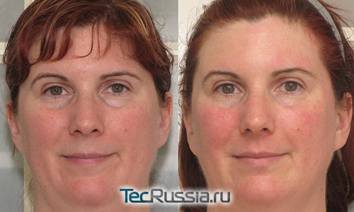 фото до и после микротоков для лица