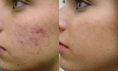 Фото до и после лазерного лечения угревой сыпи