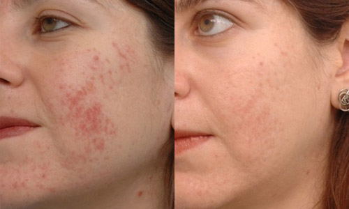 Фото до и после лечения акне лазером