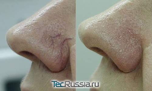фото до и после удаления телеангиоэктазий с носа лазером