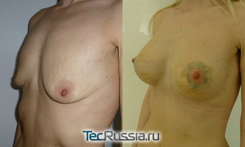 до и после мастопексии (профиль)