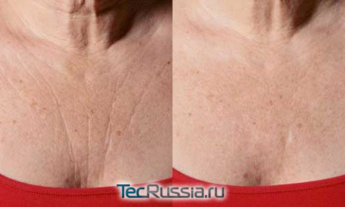 фото до и после коррекции морщин на груди