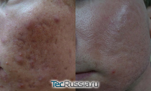 коррекция рубцов филлером Juvederm Volbella