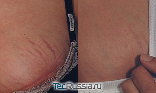 фото до и после лазерного удаления растяжек на груди