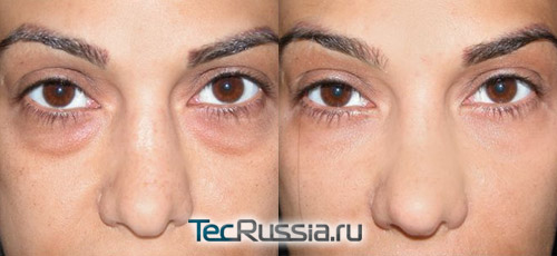 фото до и после коррекции синяков под глазами липофилингом