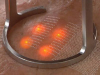 Лазерное омоложение: восстанавливаем кожу изнутри