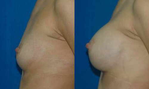Фото до и после эндоскопического увеличения груди