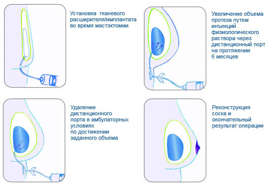 Одноэтапная реконструкция груди имплантами