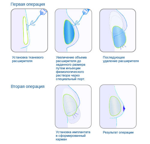 Двухэтапная реконструкция груди имплантами