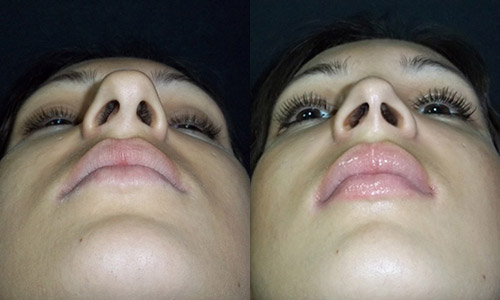 пациентка 2 до и после ринопластики, вид носа снизу, хирург Алексанян Тигран Альбертович