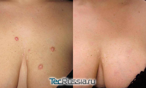 до и после удаления келоидных рубцов на груди