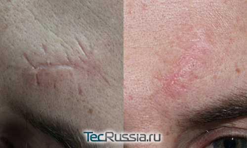 фото до и после лазерного удаления шрама со лба