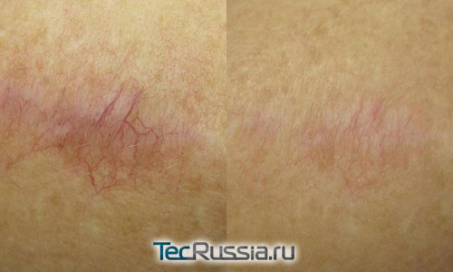 удаление лазером шрама на плече, фото до и после 4-х процедур