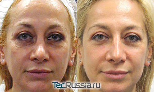 оксимезотерапия без уколов, фото до и после курса процедур