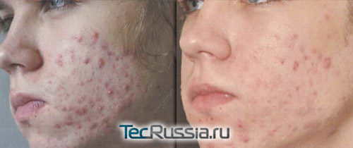 лечение акне на аппарате PlasmaJet Derma, фото до и после